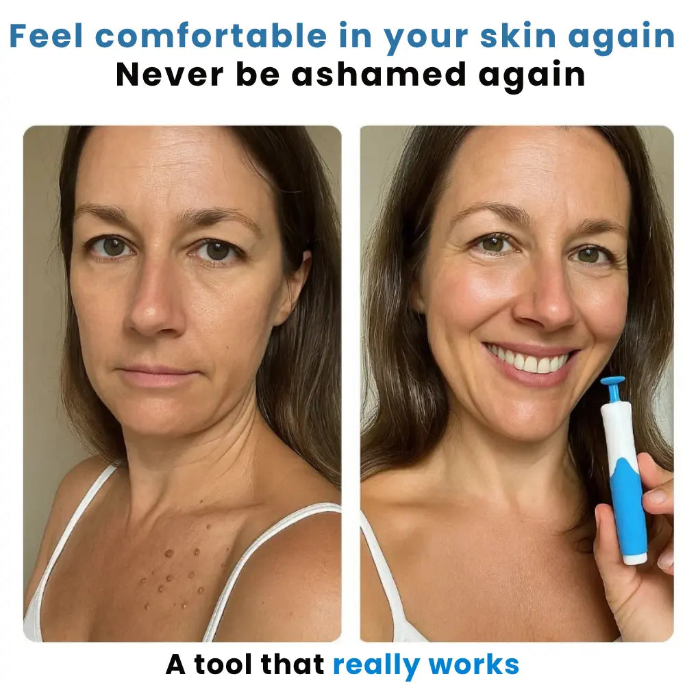 Charmora™ Skin Tag Remover Kit — Gentle, Fast & Pain-Free