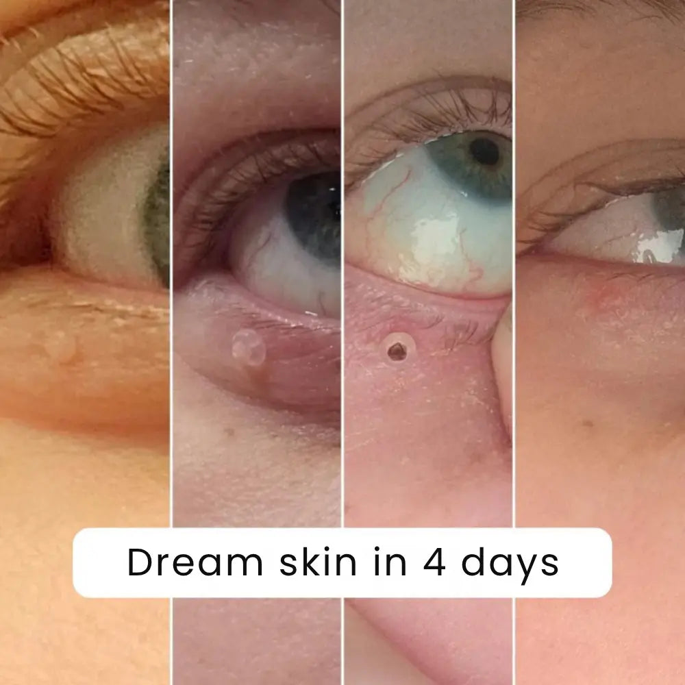 Charmora™ Skin Tag Remover Kit — Gentle, Fast & Pain-Free