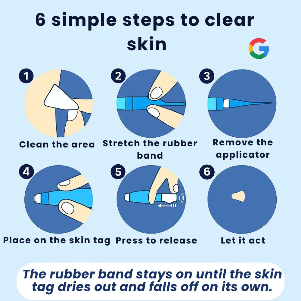 Charmora™ Skin Tag Remover Kit — Gentle, Fast & Pain-Free