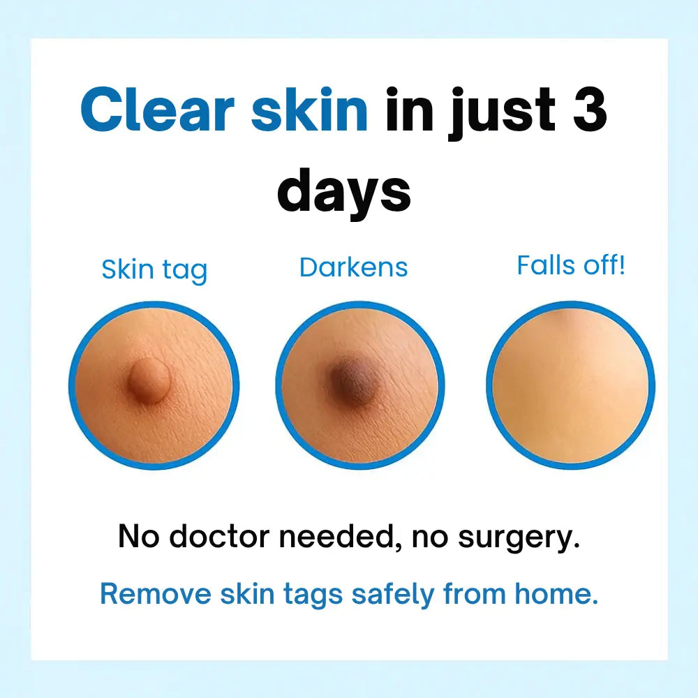 Charmora™ Skin Tag Remover Kit — Gentle, Fast & Pain-Free